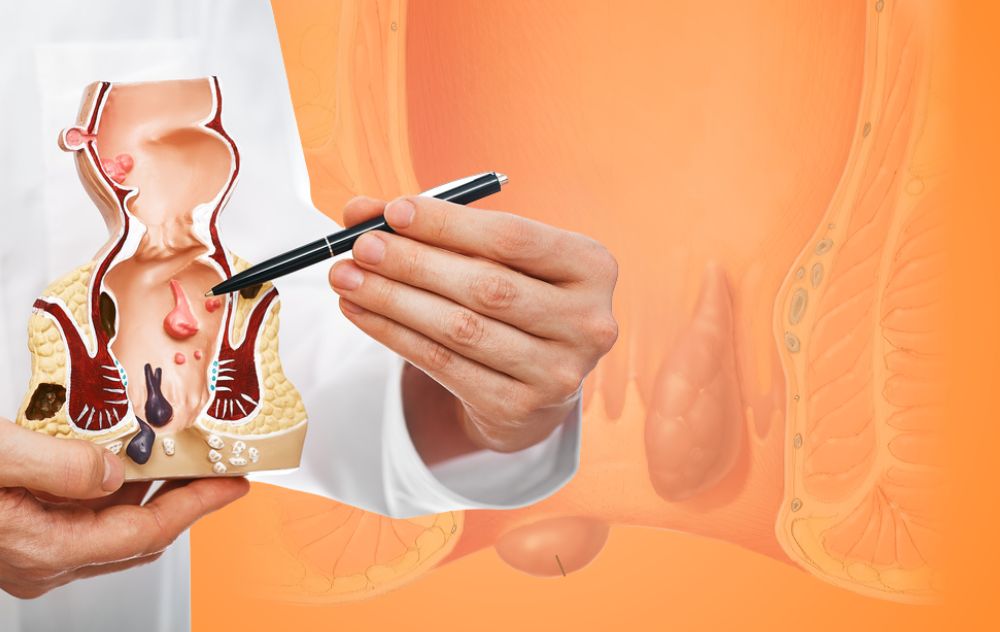 Doctor Explaining Difference between internal and external hemorrhoids