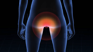 Internal vs. External Hemorrhoids What’s the Difference
