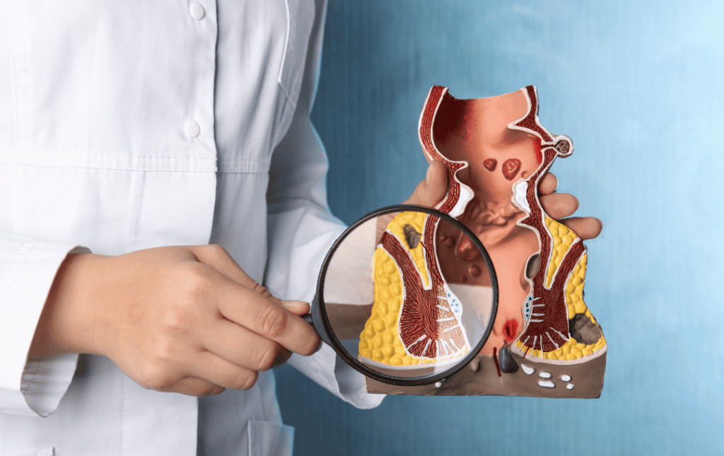 Difference Between Hemorrhoids & Anal Fissures