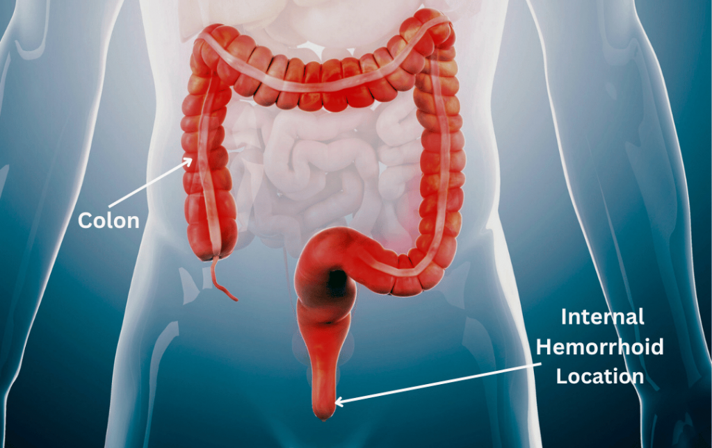 Do Internal Hemorrhoids Go Away On Their Own