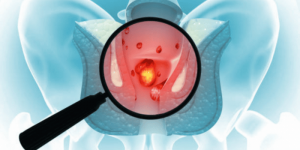 Hemorrhoid stages