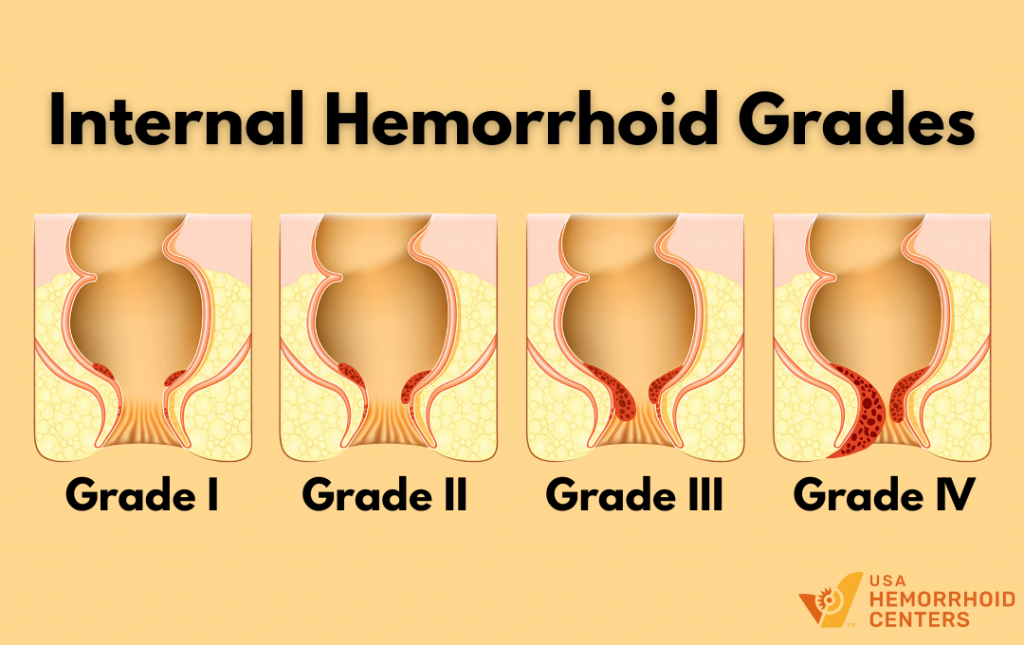 Hemorrhoid Grading System Stages Degree Classification