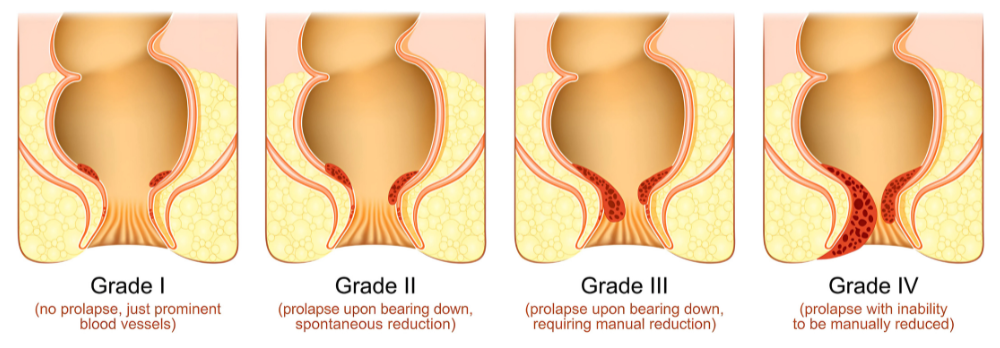 Hemorrhoid Grading System Stages Degree Classification