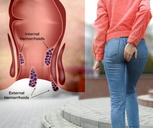  Internal Hemorrhoid Diagnosis
