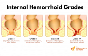 Internal Hemorrhoid Grades