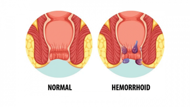 Understanding Hemorrhoid Swelling