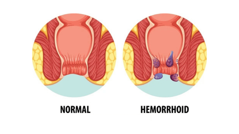 Hemorrhoid Symptoms: Swelling