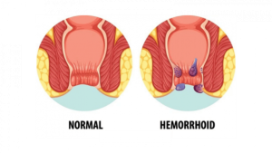 Hemorrhoid Symptoms: Swelling