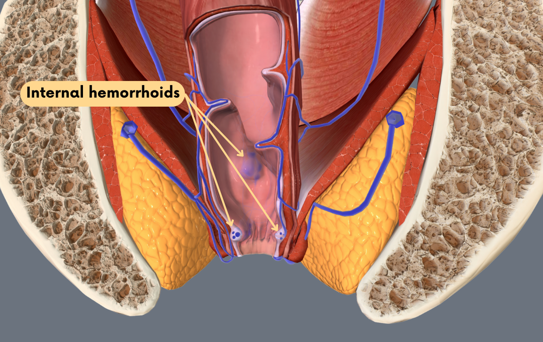 hemorrhoid artery embolization is very effective against internal hemorrhoids