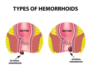 What Does an Internal and External Hemorrhoid Look Like?