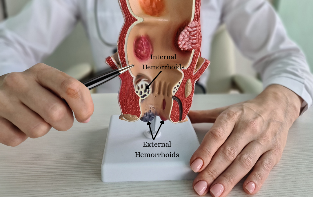 understanding hemorrhoids and treatment tiers