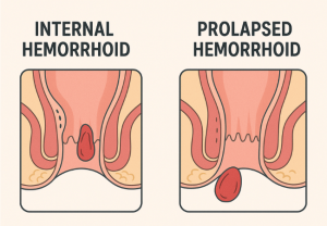 Internal Hemorrhoid & Prolapsed Hemorrhoid