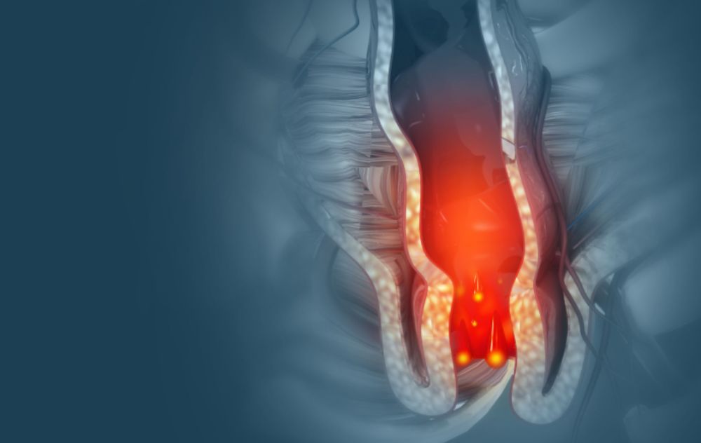 Hemorrhoid Arter Embolization or Sclerotherapy for Hemorrhoid Treatment