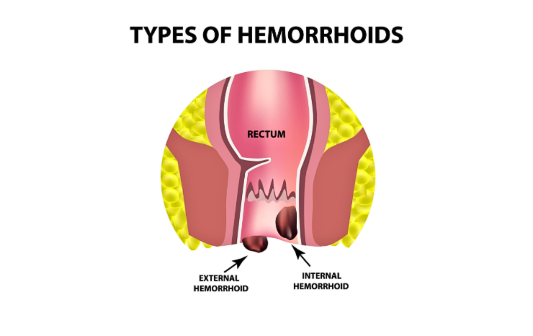 Diagram of internal and external hemorrhoids.