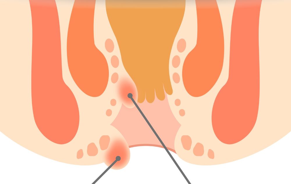Example of Hemorrhoids