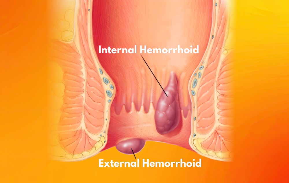 Internal vs External Hemorrhoids