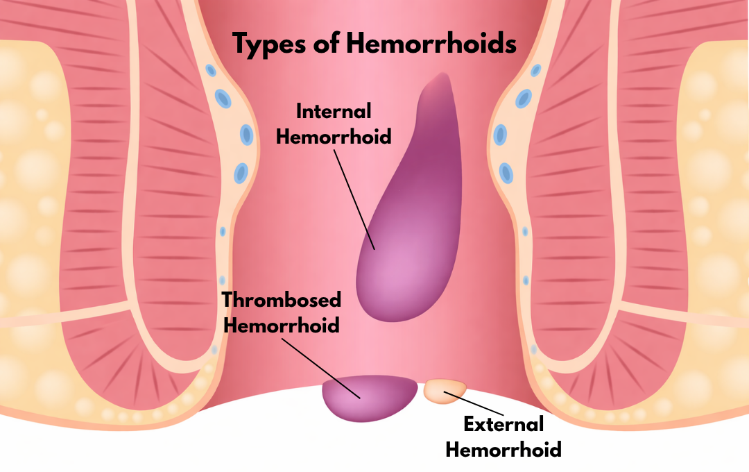 Diagram of the different types of hemorrhoids, which include internal, external and thrombosed hemorrhoids.