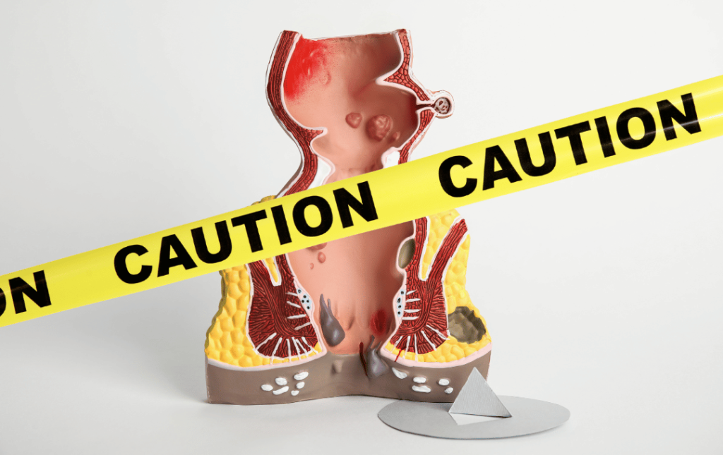 3D diagram of a rectum with hemorrhoids. Caution tape goes across the screen to illustrate whether hemorrhoids are dangerous.